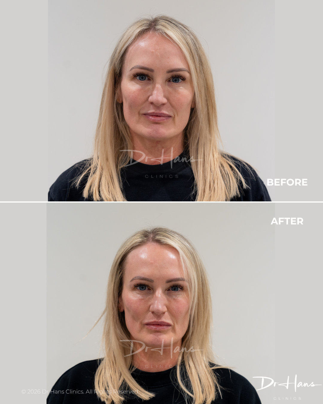 Side-by-side portraits of a blonde woman before (top) and after (bottom) cosmetic treatment at Dr Hans Clinics.