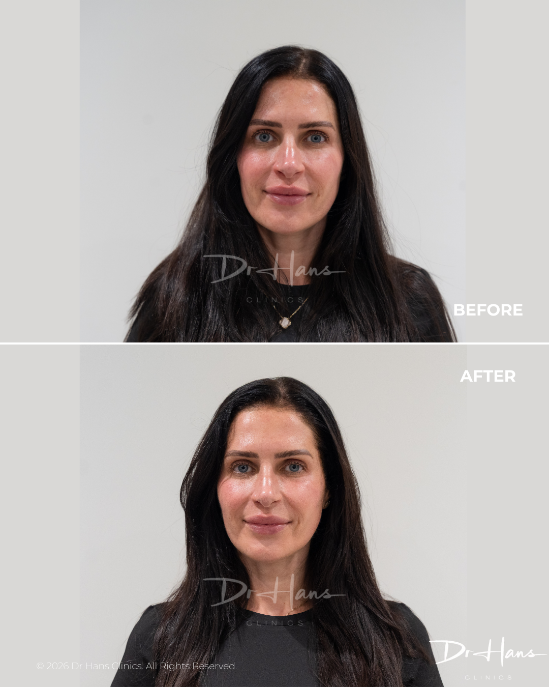 Before-and-after portrait of a woman showing facial improvement after treatment, with lighter, more even skin tone in the lower panel.