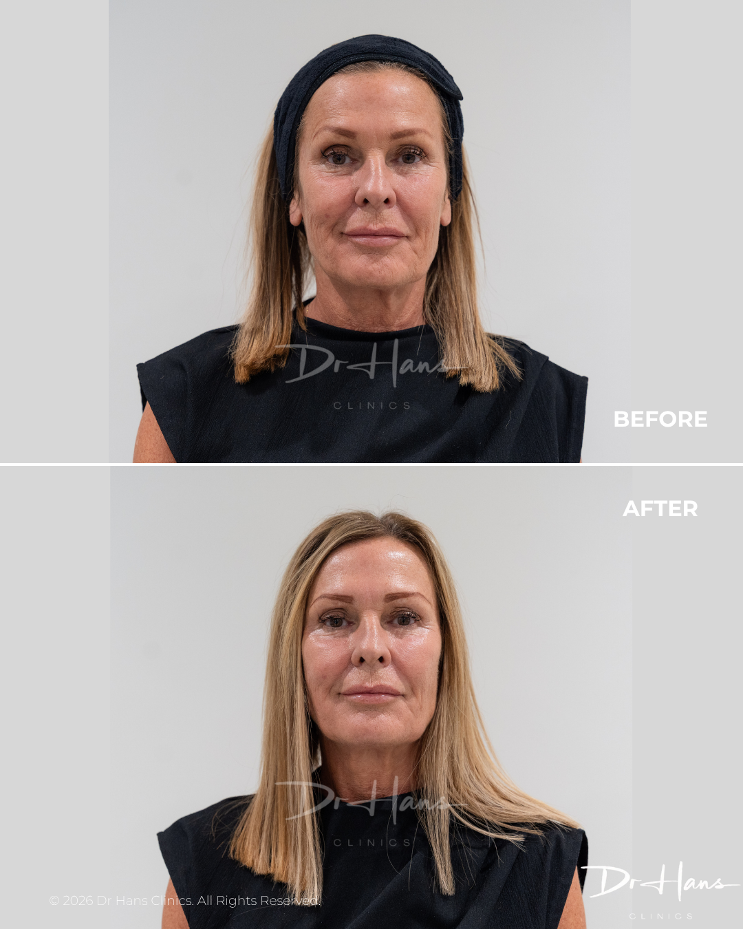 Before-and-after portrait of a woman showing facial rejuvenation results, grey background, treatment clinic branding visible (Dr Hans Clinics).