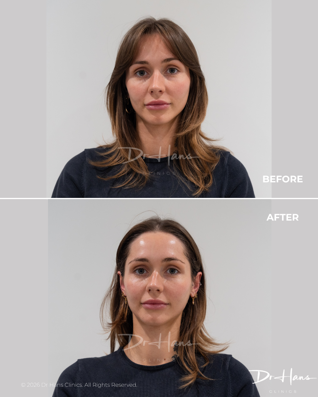Two-panel portrait comparing before and after treatment: top 'BEFORE' with natural skin, bottom 'AFTER' with smoother, radiant complexion.