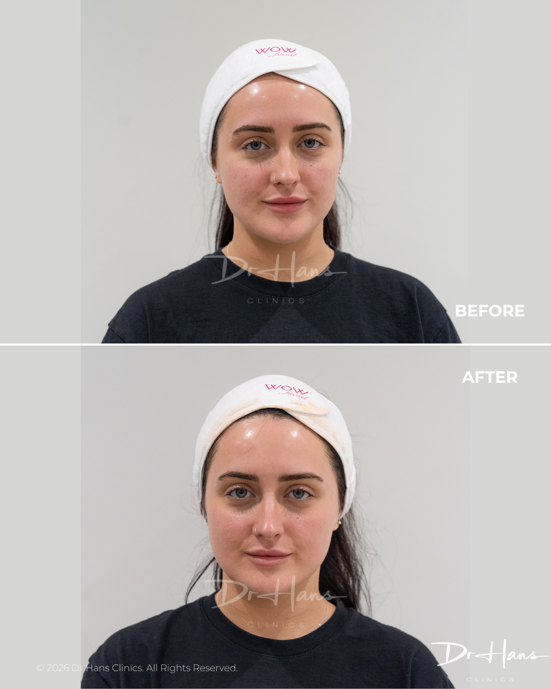 Side-by-side portrait of a woman before (top) and after (bottom) treatment, wearing a white headband and black shirt.