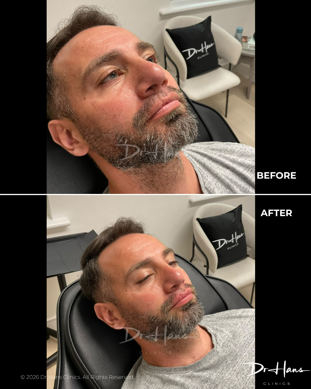 DrHans - Before After - Lip 1 - Dr Hans Clinics Before and after photos showing a man with fuller beard growth after treatment; facial hair appears denser in the 'After' image.
