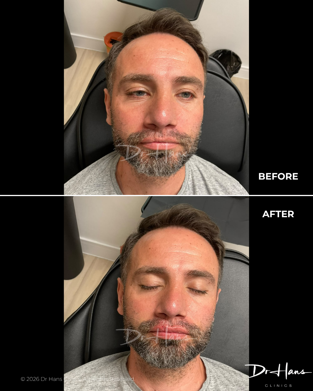 DrHans - Before After - Lip - Dr Hans Clinics Comparison photo: before and after beard grooming on a man in a clinic chair; top labeled BEFORE with a lighter, uneven beard, bottom labeled AFTER with a fuller, neater beard (eyes closed).
