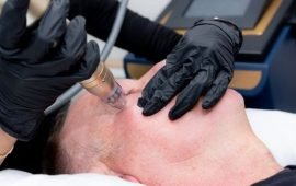 RF-Microneedling RF-Microneedling