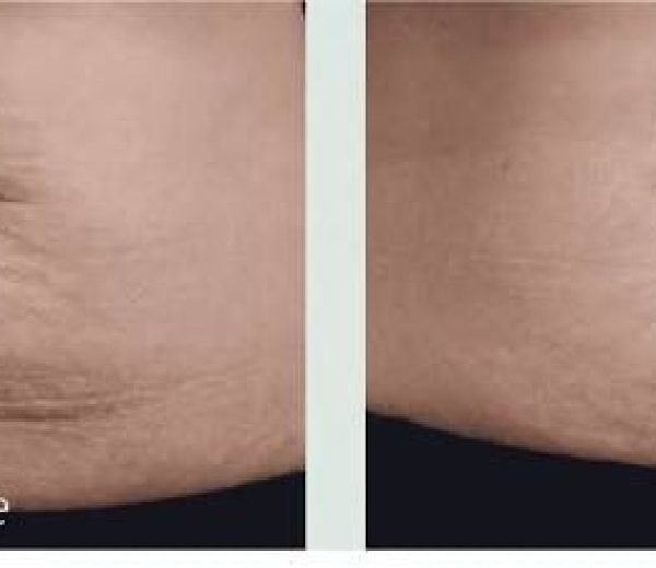 Tixel for Stretch Marks: Best Stretch Mark Treatment